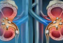 ಕಿಡ್ನಿ ಸ್ಟೋನ್ ಸಮಸ್ಯೆ: ಇದನ್ನ ಅತಿಯಾಗಿ ಬಳಸಬೇಡಿ ಮತ್ತು ಆಹಾರ ಪದ್ಧತಿಯ ಬಗ್ಗೆ ಎಚ್ಚರಿಕೆ ಇರಲಿ!