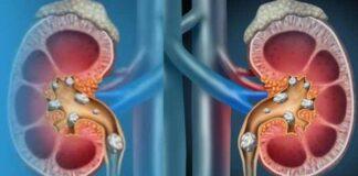 ಕಿಡ್ನಿ ಸ್ಟೋನ್ ಸಮಸ್ಯೆ: ಇದನ್ನ ಅತಿಯಾಗಿ ಬಳಸಬೇಡಿ ಮತ್ತು ಆಹಾರ ಪದ್ಧತಿಯ ಬಗ್ಗೆ ಎಚ್ಚರಿಕೆ ಇರಲಿ!