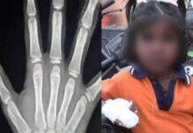 ಶಾಲಾ ಬಾಗಿಲಿಗೆ ಸಿಲುಕಿ ತುಂಡಾಯ್ತು ಬಾಲಕಿಯ ಬೆರಳುಗಳು