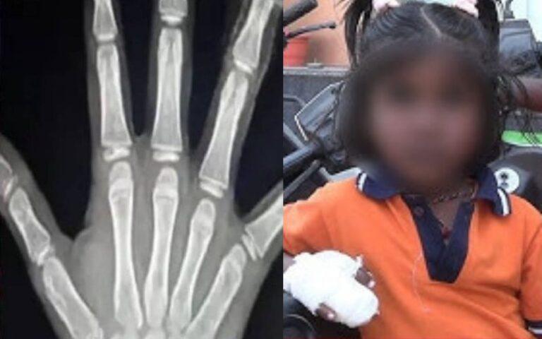 ಶಾಲಾ ಬಾಗಿಲಿಗೆ ಸಿಲುಕಿ ತುಂಡಾಯ್ತು ಬಾಲಕಿಯ ಬೆರಳುಗಳು